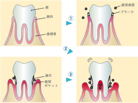 歯周病の感染の経過