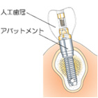 人口の歯を作成・装着